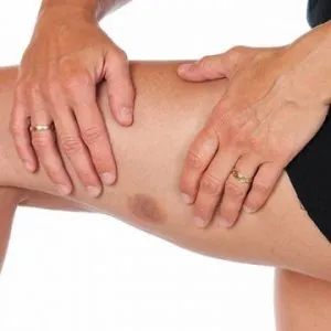 vasculitis meg vasculitis meg