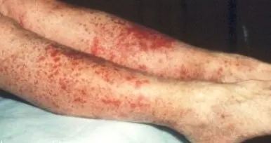 vasculitis meg vasculitis meg