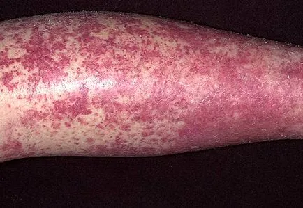 vasculitis meg vasculitis meg