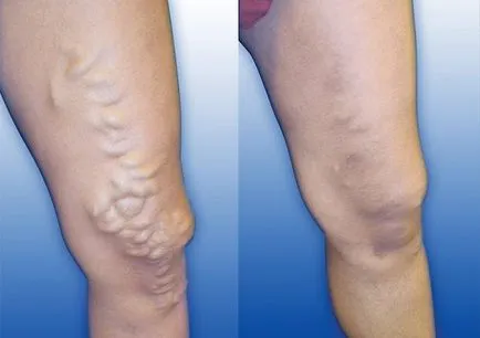 vasculitis meg