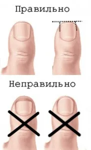Hogyan lehet megszabadulni a benőtt köröm
