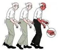 Parkinson-kór és annak kezelése