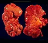 Hogyan és mit idült pyelonephritis Hogyan és mit idült pyelonephritis