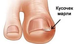 Mi köze a körmöket
