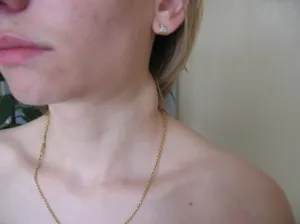 Gyulladás kezelésére a nyirokcsomók a fül mögött Gyulladás kezelésére a nyirokcsomók a fül mögött