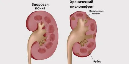 Hogyan és mit idült pyelonephritis