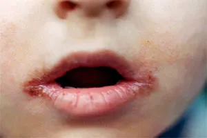 Zayed kezelése a gyermek