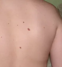 Mit csinál egy anyajegy a hátán Mit csinál egy anyajegy a hátán