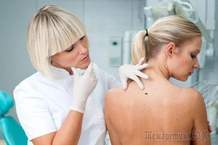 Mit csinál egy anyajegy a hátán