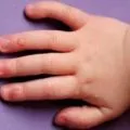 Tűnő papilloma nyakán