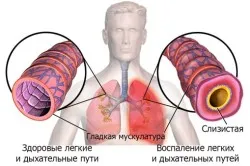 A kezelés a Staphylococcus aureus az orrban