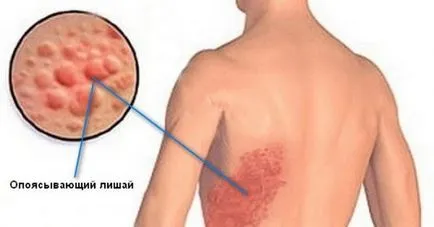 Herpes zoster zsindely kezelés