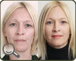 Hámló bőr vélemények