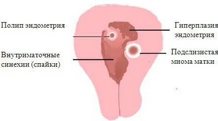 Mi endometrium szekréciós fázisban Mi endometrium szekréciós fázisban