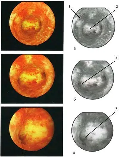Mi endometrium szekréciós fázisban