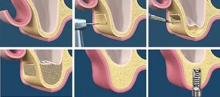 set implantátumok