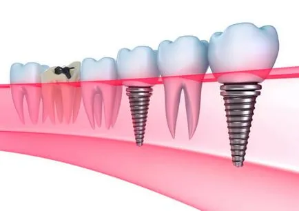 set implantátumok