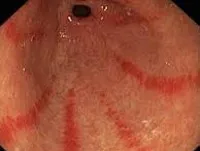 Gastro és annak kezelése