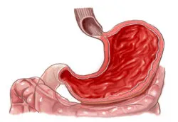 Gastro és annak kezelése