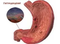 Gastro és annak kezelése