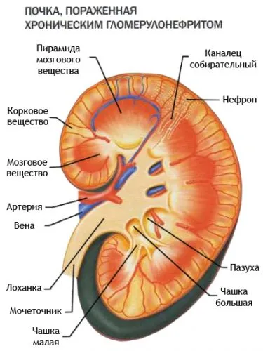 glomerulonephritis meg
