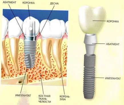 set implantátumok