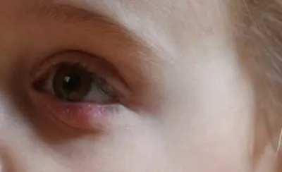 Chalazion kezelése a gyermek