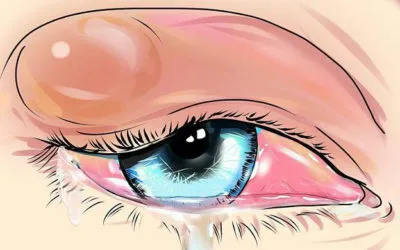 Chalazion kezelése a gyermek