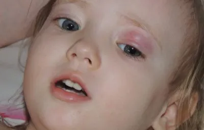 Chalazion kezelése a gyermek