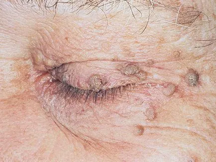 Hogyan juthat HPV