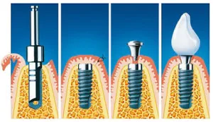 set implantátumok set implantátumok