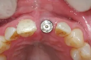 set implantátumok set implantátumok