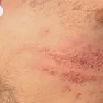 Herpes zoster zsindely kezelés