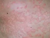 Herpes zoster zsindely kezelés