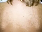 Herpes zoster zsindely kezelés