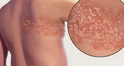 Herpes zoster zsindely kezelés