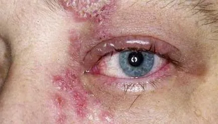Herpes zoster zsindely kezelés