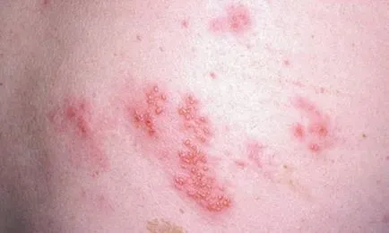 Herpes zoster zsindely kezelés Herpes zoster zsindely kezelés