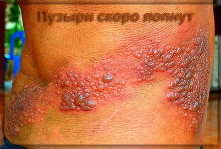 Herpes zoster zsindely kezelés