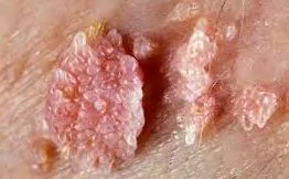 papillomatosis eltavolitasa