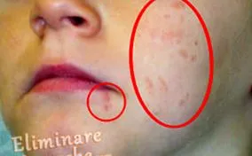 virus verruche szemölcsök