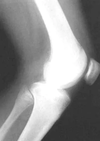 osteochondrosis