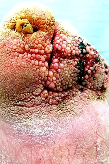 papillomatosis
