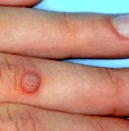 eltavolitasa epithelialis