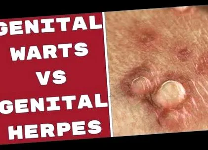 virus herpes