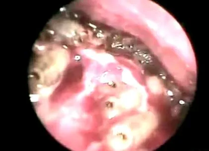 giardia