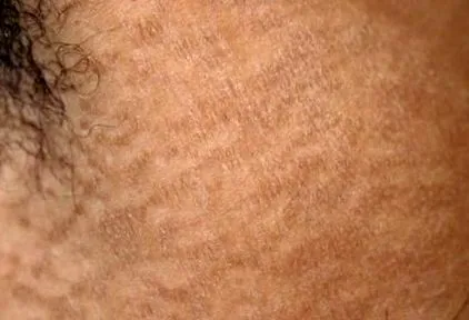 reticularis