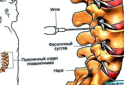 остеохондроза