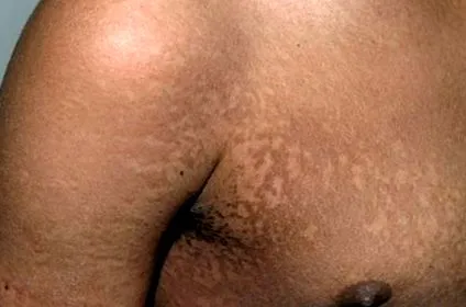 xanthelasma