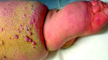 papillomatosis